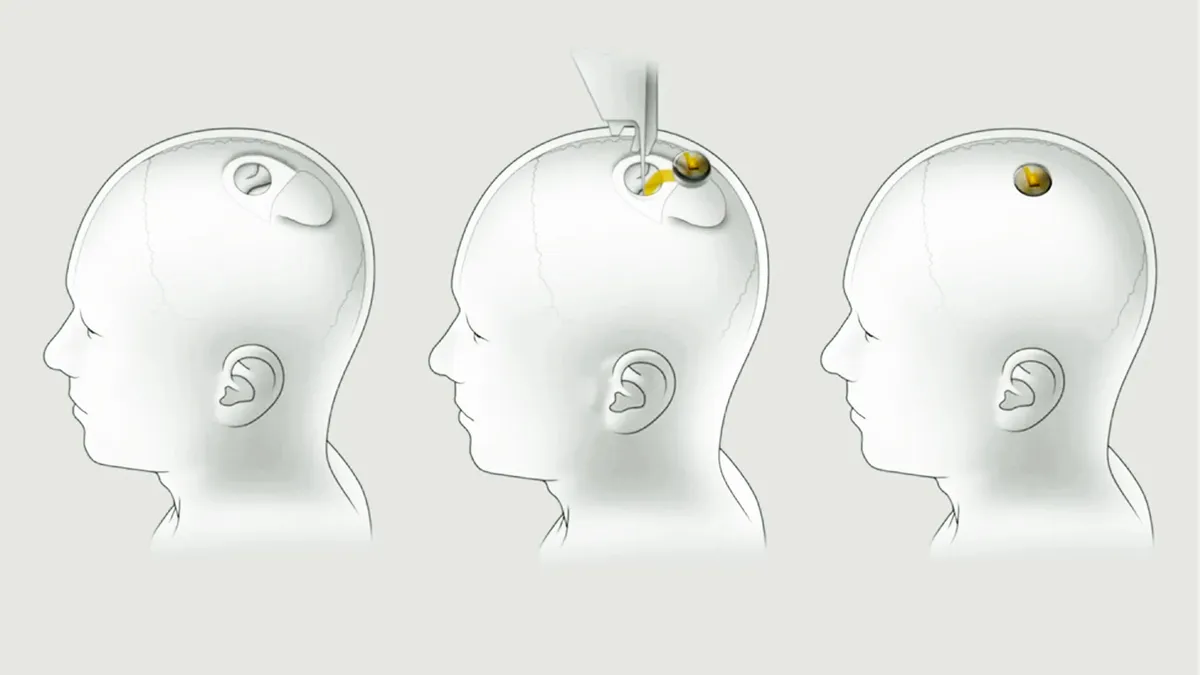 Neuralink elon musk brain chip human trials