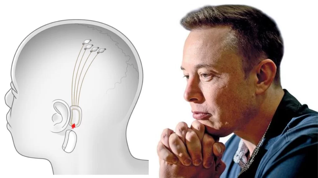 Elon Musk Calls For Volunteers For Nuralink brain chip