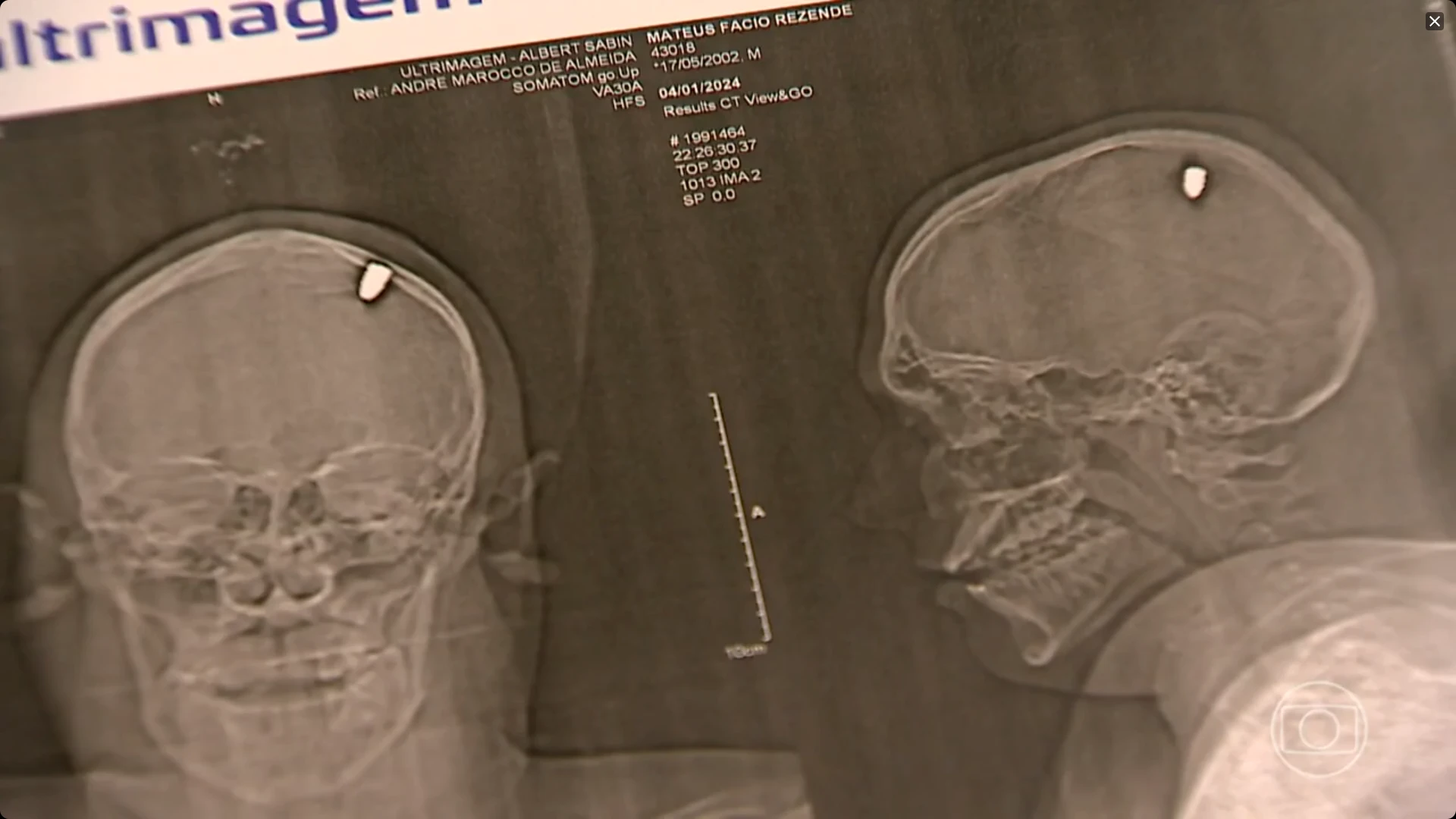 Man discovers bullet in his skull after 4 days of partying CT Scan