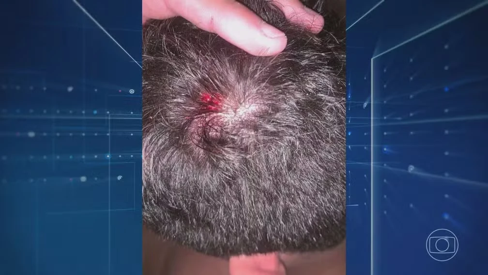 Man parties for 4 days with gunshot in the head day 1