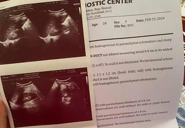 90 Day Fiance Mary and Brandan Colon Cancer Medical Record