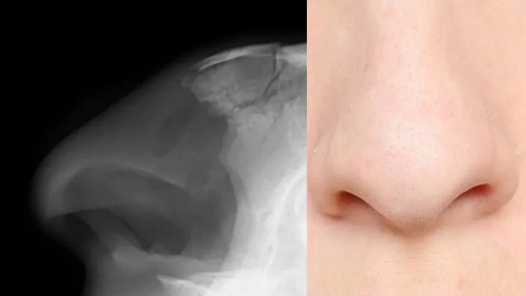 Nose Picking Health risks