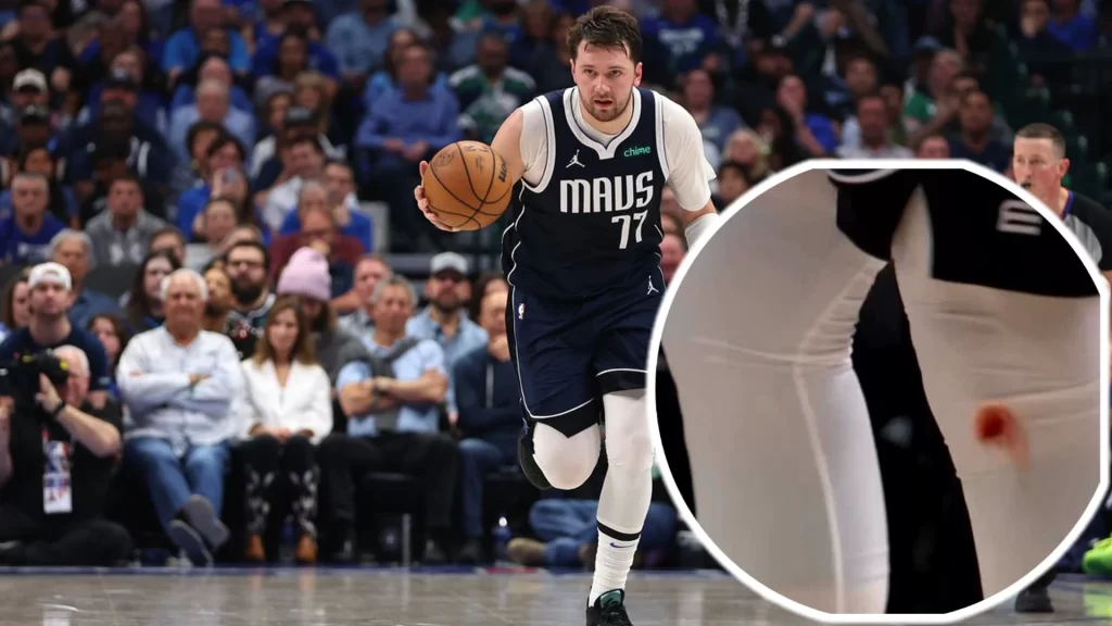 Luka Doncic's bloody knees
